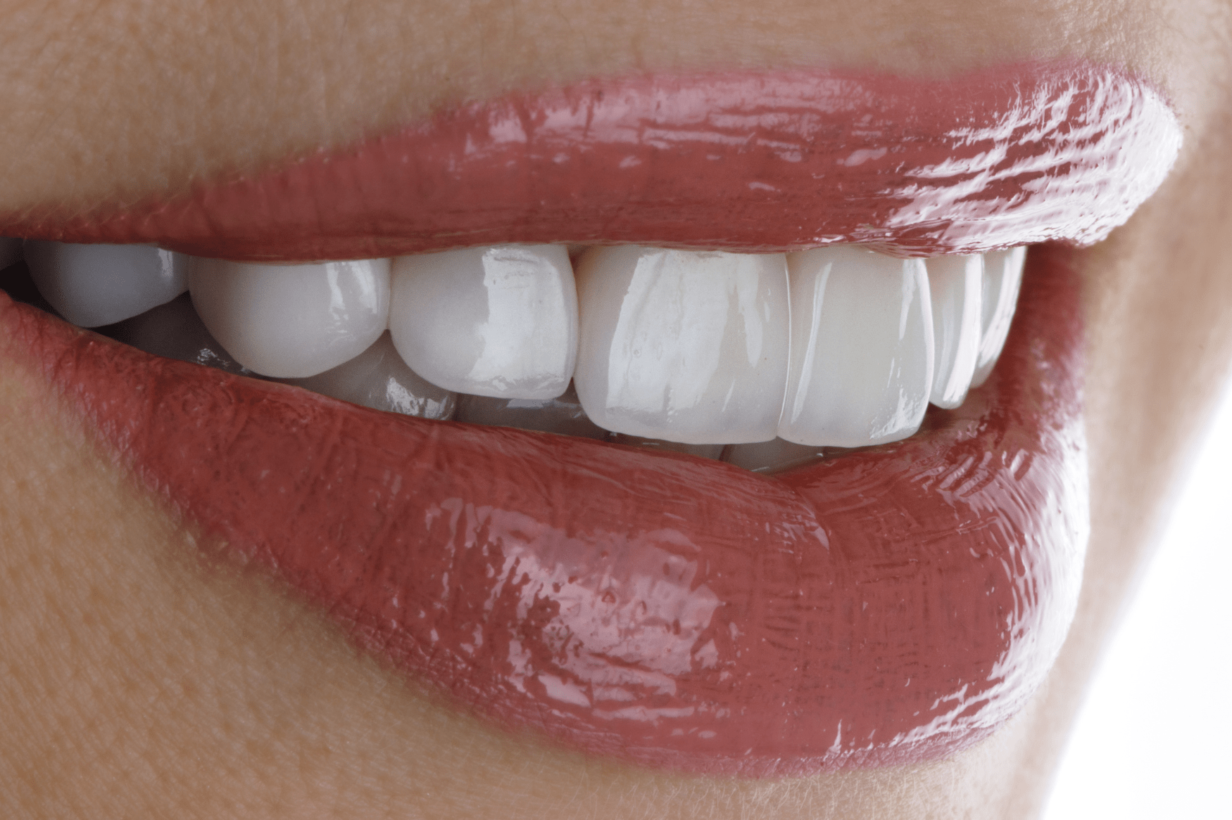 Ästhetik durch weiße Inlays für Ihre Zähne